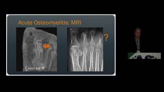 Imaging of Osteomyelitis amp Septic Arthritis  15 Minute Radiology CME [upl. by Neltiac]