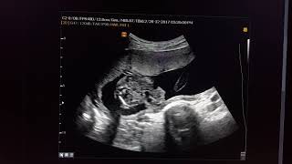 Gastroschisis Sonography [upl. by Simdars]