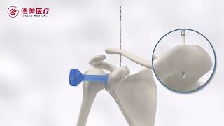 Reconstruction of acromioclavicular joint dislocation [upl. by Nazay474]