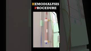 Hemodialysis Procedure shorts dialysis [upl. by Earal]