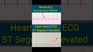 HEART ATTACK on ECG VS NORMAL ECG  You wont believe [upl. by Ztnaj2]