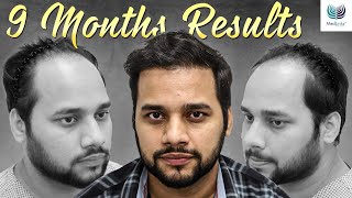 Astonishing 9 Months Results  Before and After Hair Transplant  Medlinks Delhi [upl. by Anir]