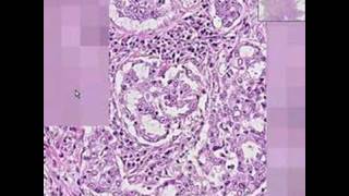 Histopathology LungAdenocarcinoma [upl. by Bradlee]