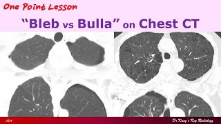 Pulmonary Blebs vs Bullae [upl. by Roht]