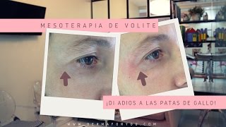 Mesoterapia de larga duración de Volite  Dermaforyou [upl. by Nerret]