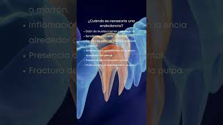 Endodoncia ¿cuándo es necesario realizarla [upl. by Refinneg]