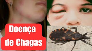 Doença de Chagas o que você precisa saber [upl. by Lindgren]