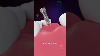 Bone Grafting for Dental Implants shorts facts  creativelearning3d [upl. by Arytal]