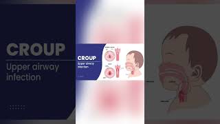 Barking cough in Croup [upl. by Adrianna410]