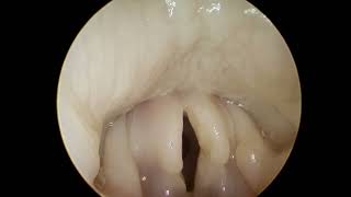 Laryngeal paralysis in a cat [upl. by Christos]