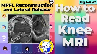 Fig 4A42 MPFL Reconstruction and Lateral Release [upl. by Iphagenia740]