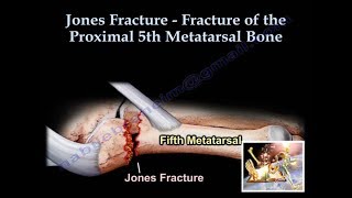 Jones Fracture  Everything You Need To Know  Dr Nabil Ebraheim [upl. by Marley]