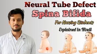 Neural tube defect nursing  spina bifida [upl. by Raychel]