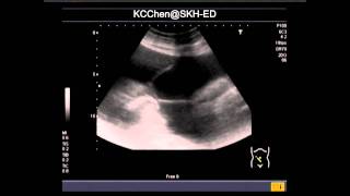 Sclerosing Encapsulating Peritonitis [upl. by Auhsuj]