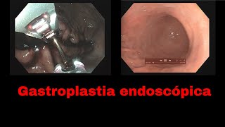 Gastroplastia endoscópica [upl. by Aramanta]