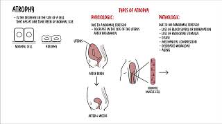 Cellular Adaptation  hyperplasia hypertrophy atrophy and metaplasia  cell injury [upl. by Schapira]