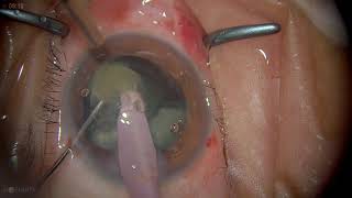 Surgery Phacoemulsification in Posterior Subcapsular Cataract [upl. by Abla]