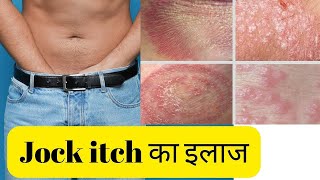 Jock itch home remedies  Jock itch treatment at home  Jock itch cream for private parts Dr Rahul [upl. by Ogata]