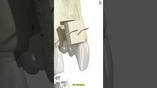 Bone Grafting Osteoporosis In Dental Implants 3D Animation [upl. by Airbas]