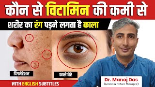 पिगमेंटेशन को जड़ से खत्म करने के उपाए  Get Rid of Hyperpigmentation Naturally  Dr Manoj Das [upl. by Collbaith]