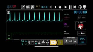 Supraventricular Tachycardia SVT Synchronised Cardioversion [upl. by Silrac]