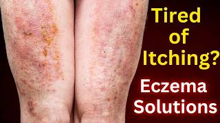 Dermatologist’s Guide to Beating Eczema [upl. by Duester1]