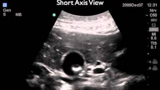 How To Gallbladder Ultrasound Part 2  Gallstones Case Study Video [upl. by Thea]