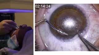 London Vision Clinic  ReLEx SMILE  Live laser eye surgery  Professor Dan Reinstein [upl. by Megan]