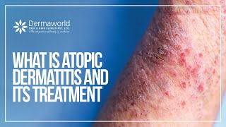 What is atopic dermatitis and its Treatment  Dr Rohit Batra  Dermaworld Delhi [upl. by Aniv]