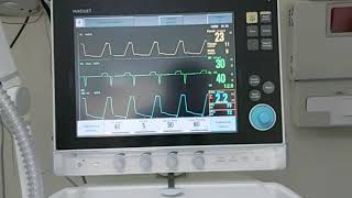 Workshop 17 How to apply Expiratory hold or pause In MAQUET SERVO I  Auto PEEP mechanical ventil [upl. by Barbour955]