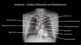 How to Interpret a Chest XRay Lesson 2  A Systematic Method and Anatomy [upl. by Rosabelle876]