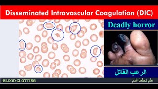 Lecture 24 Disseminated Intravascular Coagulation  DIC [upl. by Carthy420]