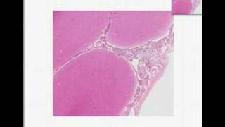 Histopathology Brain Acute pyogenic bacterial meningitis [upl. by Kristen]