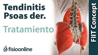 Tratamiento de la tendinitis del psoas derecho o psoitis derecha [upl. by Hairahcaz267]