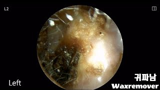 ep35 Earwax removal [upl. by Merrell]