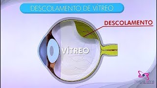 Descolamento de vítreo posterior [upl. by Ytsud32]