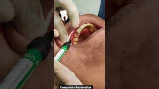 Cervical Abrasion composite aceinstituteofdentistry [upl. by Harald877]