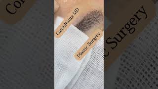 eyebrow hair transplant [upl. by Zinn760]