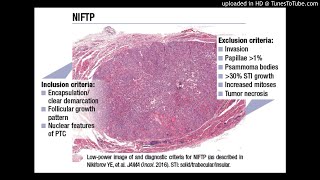 Noninvasive Follicular Neoplasm with Papillarylike Nuclear Features NIFTP [upl. by Aicilanna415]