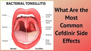 What Are the Most Common Cefdinir Side Effects [upl. by Lourie375]