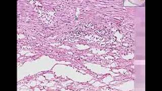 Histopathology ColonIschemic enterocolitis [upl. by Erej]