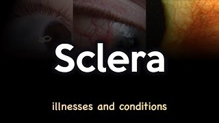 Sclera Illnesses and Conditions [upl. by Orelle]