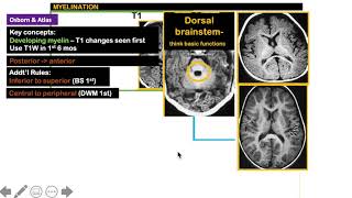 Myelination in MRI 44 simplified [upl. by Aridnere956]