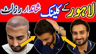 Best Hair Transplant Clinic in Lahore  Hair Transplant in Pakistan  hair Transport Price [upl. by Isacco]