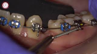 closed coil spring in orthodontic canine traction asker orthodontics [upl. by Bellda11]