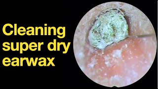 Cleaning super dry earwax ear wax removal  ear cleaning  ASMR  relaxation  relax [upl. by Lebasiram]