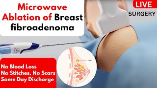 Microwave Ablation of Breast fibroadenoma  Non Surgical Treatment  Without Surgery [upl. by Turtle]