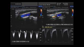 stenosi dellarteria carotide interna sinistra  ICA [upl. by Anivram258]