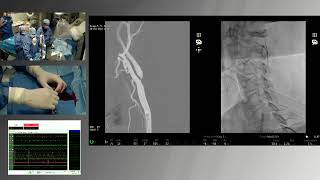 Protected Carotid Artery Stenting with MicroNet Carotid Stent Incathlab Case of the month Nov 22 [upl. by Serra]