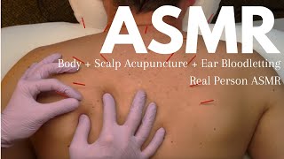 Upper Back  Scalp Acupuncture Treatment and a TINY bit of Bloodletting 😇❣️ Real Person ASMR [upl. by Yluj]